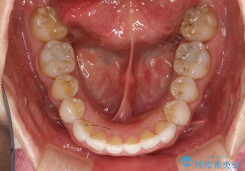 抜歯せずに八重歯のマウスピース矯正の治療後