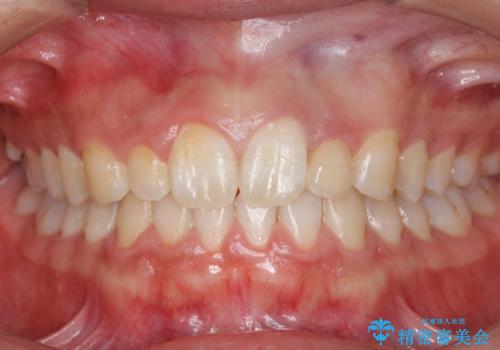 前歯のすきま　矯正治療とセラミックで小さな歯を形良くの症例 治療後