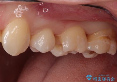 一度治療した歯が虫歯に セラミックインレーで治療の治療中