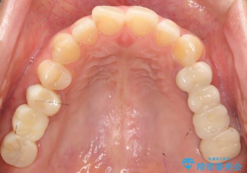 自家歯牙移植 使っていない親知らずを移植 20代女性の治療後
