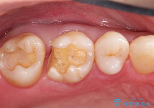 むし歯の治療。ゴールドインレーによる修復の治療中