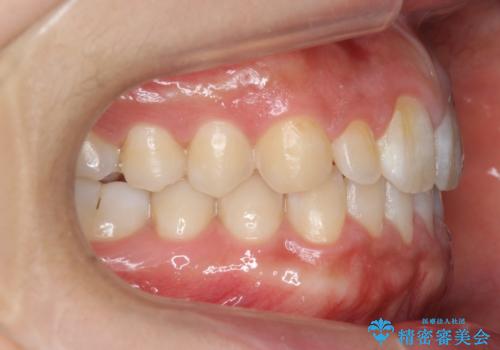 前歯のすきま 矯正治療とセラミックで小さな歯を形良くの治療後