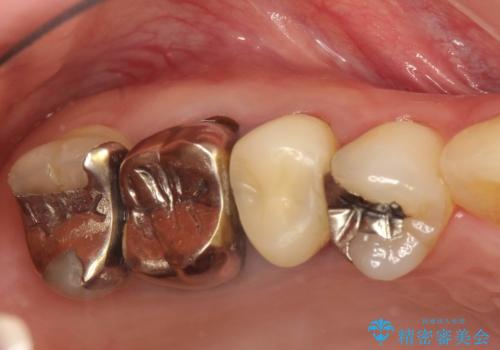 歯周外科・根管治療による長期予後を期待する奥歯の治療の治療前