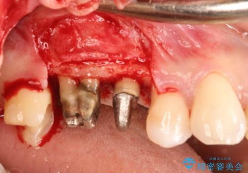 歯周外科・根管治療による長期予後を期待する奥歯の治療の治療中