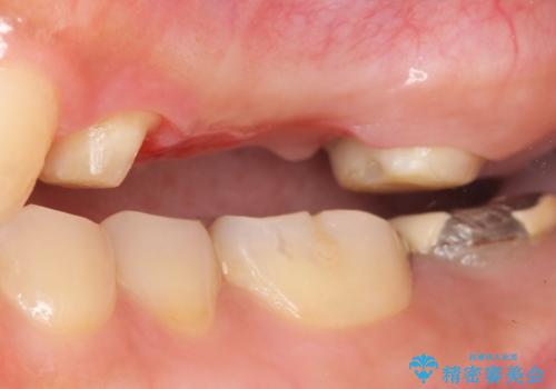 自家歯牙移植 使っていない親知らずを移植 20代女性の治療中