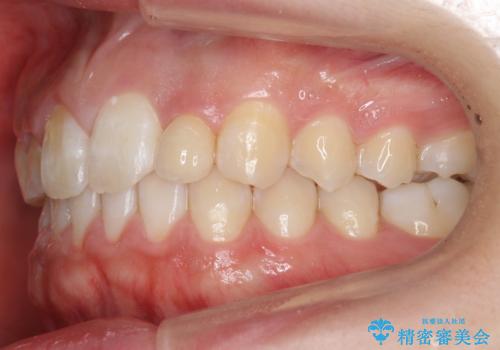 前歯のすきま　矯正治療とセラミックで小さな歯を形良くの治療後