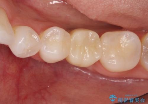 深い虫歯により抜歯となった奥歯　インプラント治療でかみ合わせを回復するの治療後