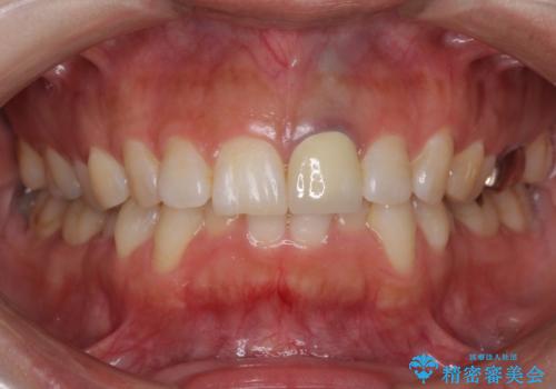 前歯のメタルをセラミックにしたい　歯自体が変色している場合の参考用の治療後