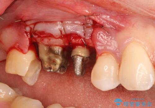 歯周外科・根管治療による長期予後を期待する奥歯の治療