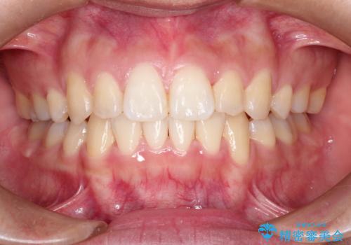 前歯が八重歯でガタガタ　ワイヤーによる抜歯矯正の症例 治療後