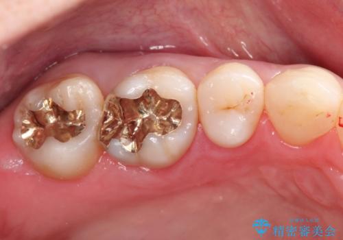 むし歯の治療。ゴールドインレーによる修復の症例 治療後