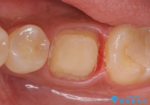 オールセラミッククラウン 根管治療後の補綴の治療中