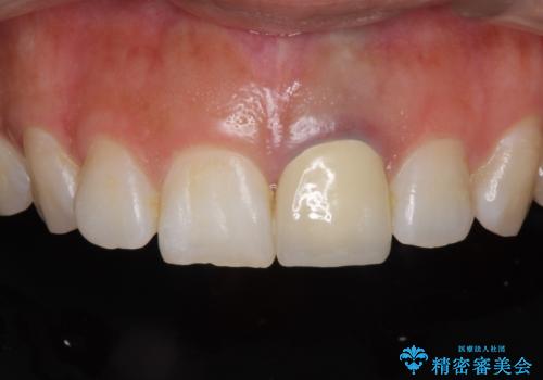 前歯のメタルをセラミックにしたい　歯自体が変色している場合の参考用の治療後