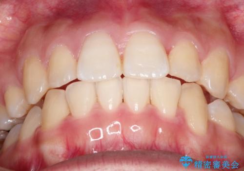 前歯が八重歯でガタガタ ワイヤーによる抜歯矯正の治療後