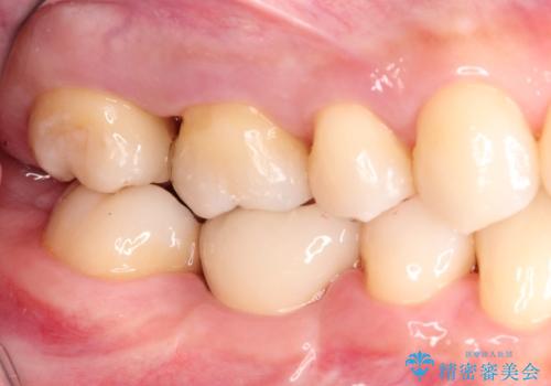 むし歯の治療。ゴールドインレーによる修復の治療後