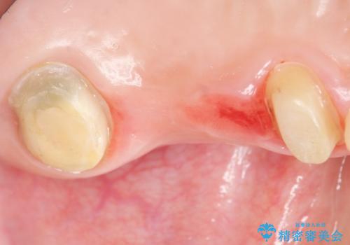 自家歯牙移植 使っていない親知らずを移植 20代女性の治療前