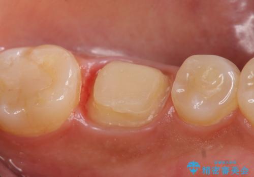 オールセラミッククラウン 根管治療後の補綴の治療中