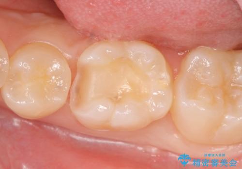 セラミックインレー しみる歯の治療の治療中