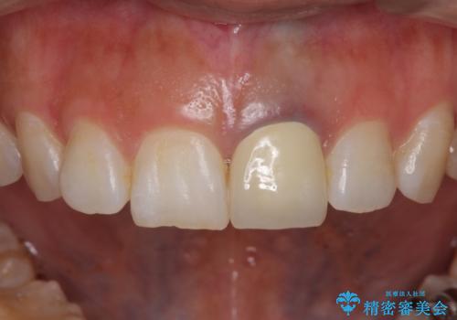 前歯のメタルをセラミックにしたい 歯自体が変色している場合の参考用の治療後
