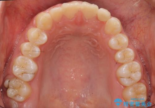 前歯のすきま 矯正治療とセラミックで小さな歯を形良くの治療後