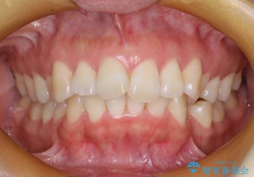 抜歯をして前歯を下げ、ガタつきを取り除く ワイヤー矯正の治療前