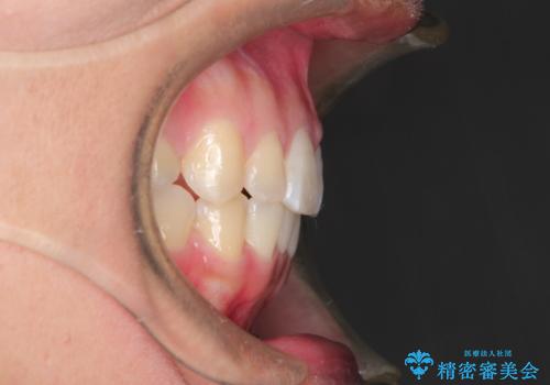 前歯が八重歯でガタガタ　ワイヤーによる抜歯矯正の治療後