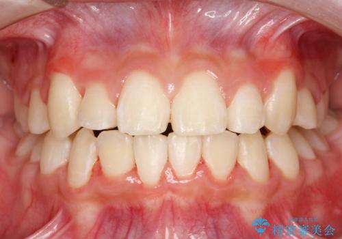 永久歯が生えてこない ワイヤー矯正で複雑な状態を正常咬合へ誘導するの治療後