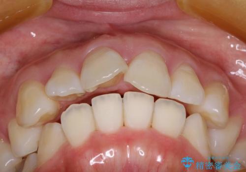 抜歯をして前歯を下げ、ガタつきを取り除く ワイヤー矯正の治療前