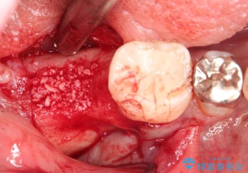 奥歯が痛い。骨増生を併用したインプラントの治療後