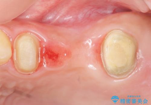 自家歯牙移植 使っていない親知らずを移植 20代女性の治療中