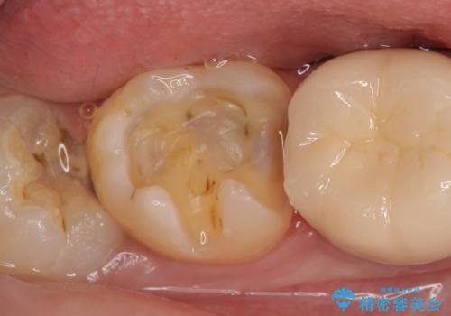 セラミックインレー 古い銀歯の治療の治療中