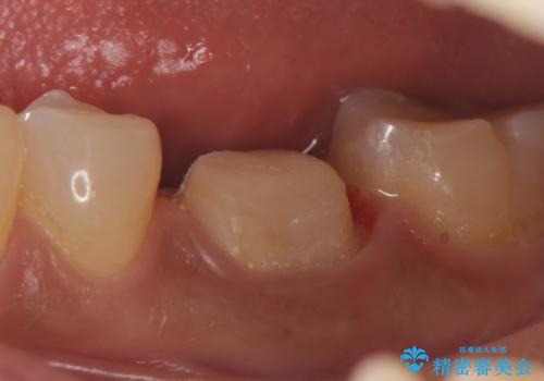 オールセラミッククラウン 根管治療後の補綴の治療中