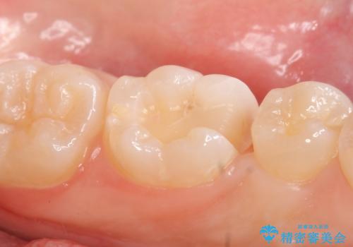 セラミックインレー しみる歯の治療の治療中