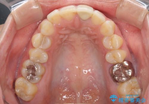 前歯のメタルをセラミックにしたい 歯自体が変色している場合の参考用の治療後