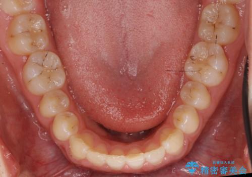 前歯のすきま 矯正治療とセラミックで小さな歯を形良くの治療後