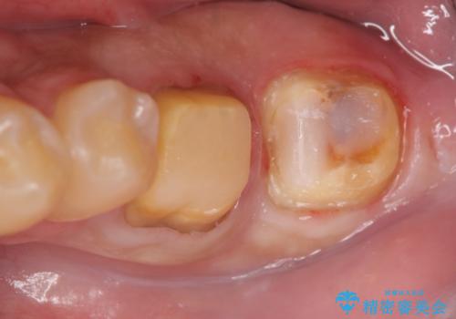 歯冠長延長術を併用した審美的歯科治療の治療中