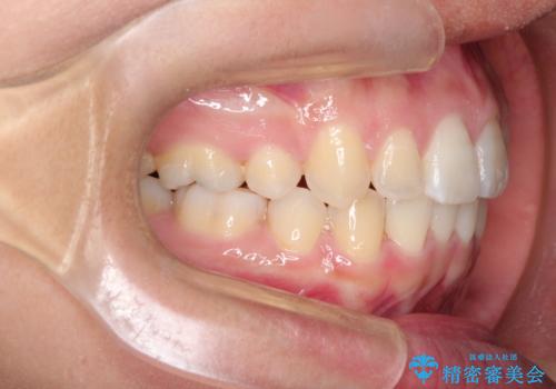 前歯が八重歯でガタガタ ワイヤーによる抜歯矯正の治療後