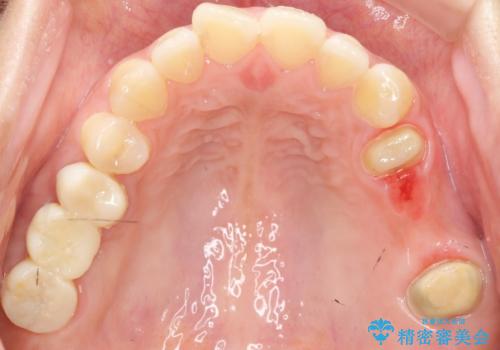 自家歯牙移植 使っていない親知らずを移植 20代女性の治療後