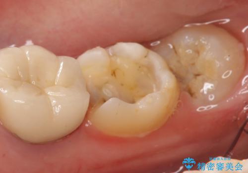 セラミックインレー 古い銀歯の治療の治療中