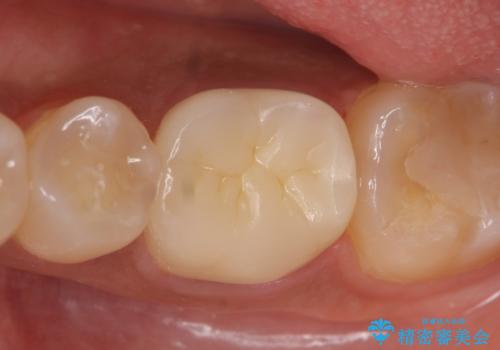 オールセラミッククラウン 根管治療後の補綴の治療後