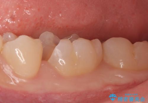 セラミックインレー しみる歯の治療の治療中