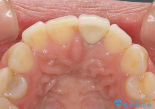 前歯のメタルをセラミックにしたい 歯自体が変色している場合の参考用の治療後