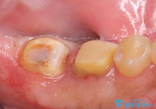 歯冠長延長術を併用した審美的歯科治療の治療中