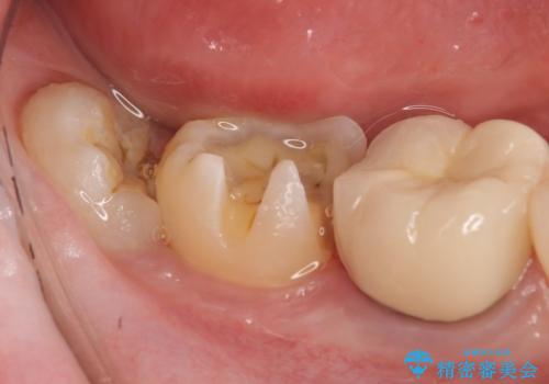 セラミックインレー 古い銀歯の治療の治療中