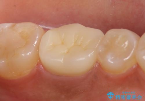 オールセラミッククラウン 根管治療後の補綴の治療後