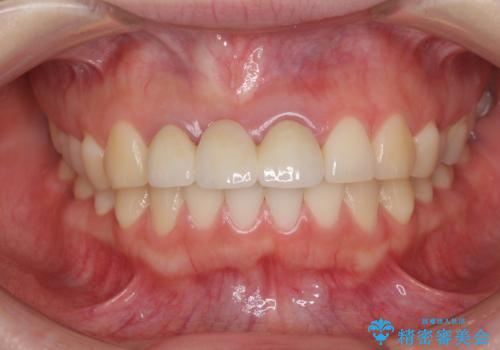 歯肉から血が　前歯のオールセラミックブリッジの再製作の治療前