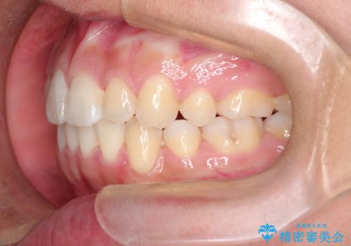 前歯が八重歯でガタガタ ワイヤーによる抜歯矯正の治療後