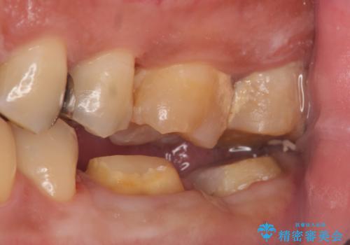 歯冠長延長術を併用した審美的歯科治療の治療中