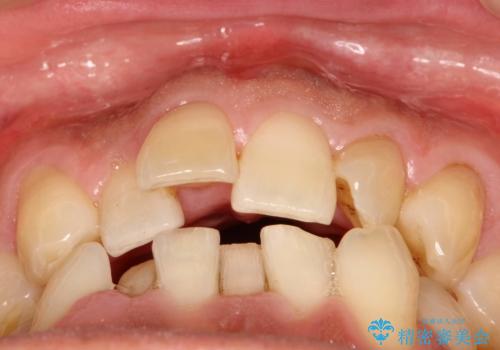 インビザライン invisalign ガタつきを治すマウスピース矯正の治療前