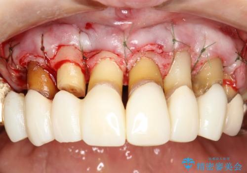 前歯の低クオリティな治療の実態　妥協無い治療で根本からやり治すの治療中